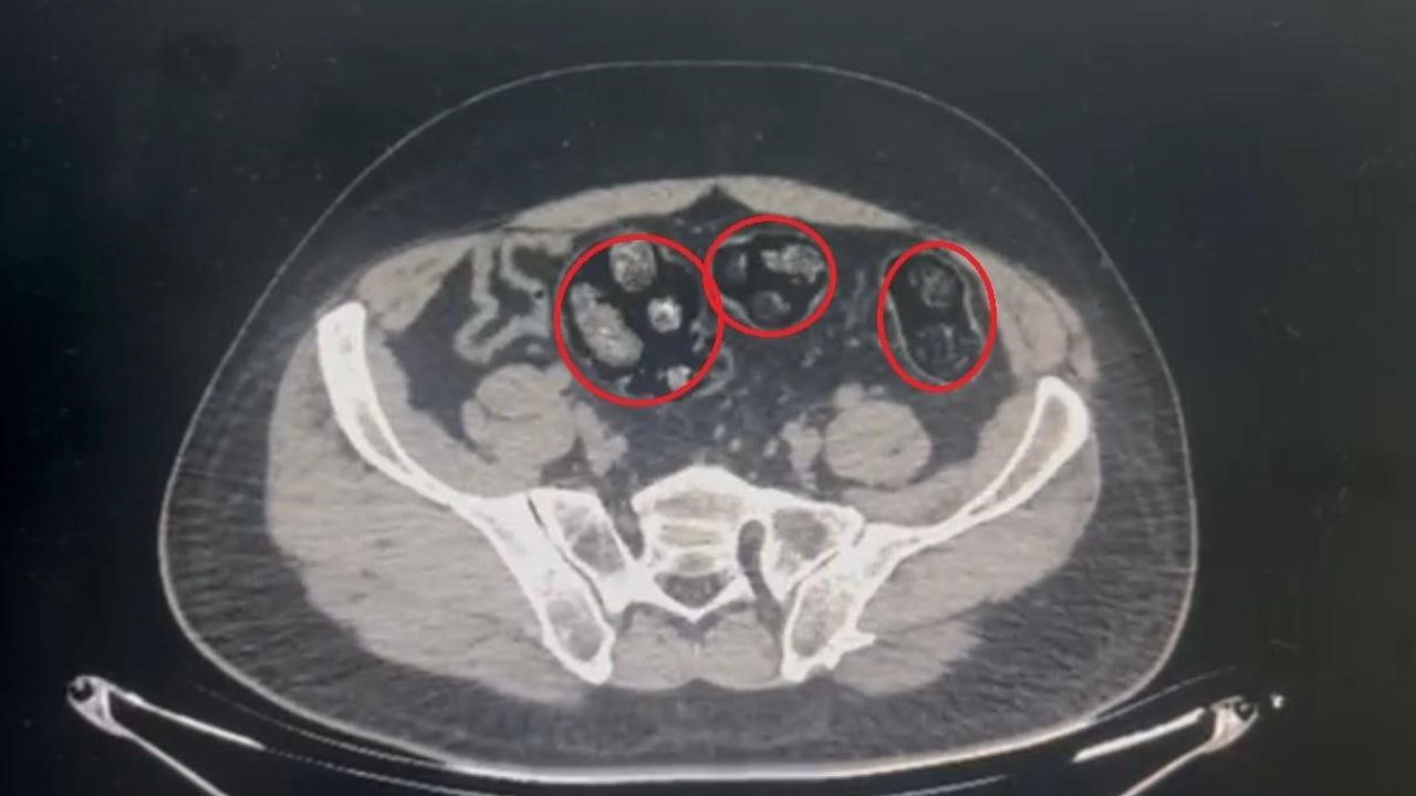 Yolcunun midesinden 62 parça uyuşturucu çıktı